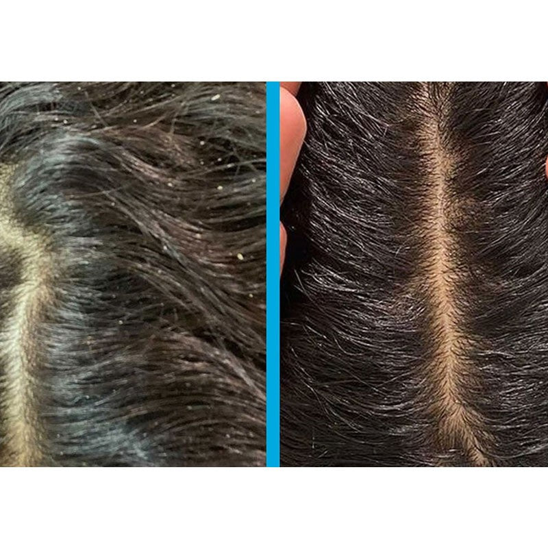 Umberto Giannini Scalp Scrub Exfoliating Anti Dandruff Treatment